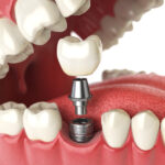 Closeup of a dental implant replacing a missing tooth