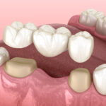 dental bridge, missing teeth, dental bridges, teeth replacement, restorative dentistry, dentist in Amarillo