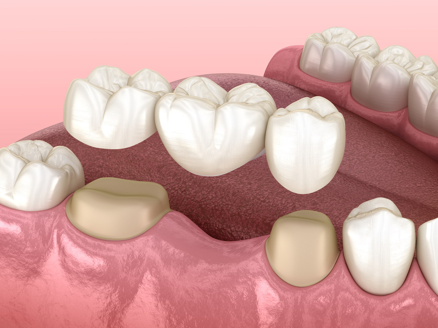 dental bridge, missing teeth, dental bridges, teeth replacement, restorative dentistry, dentist in Amarillo