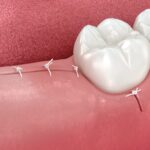 oral surgery recovery, Windmill Dental, Amarillo TX, Dr. Austin A. Whetten, post-operative care, dental surgery tips, managing pain after surgery, oral health, recovery tips, dental care