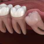 tooth extraction, dental care, gum disease, wisdom teeth, severe tooth decay, oral health tips, tooth extraction Amarillo, dentist amarillo