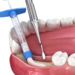 bone grafting to restore bone level before dental implant
