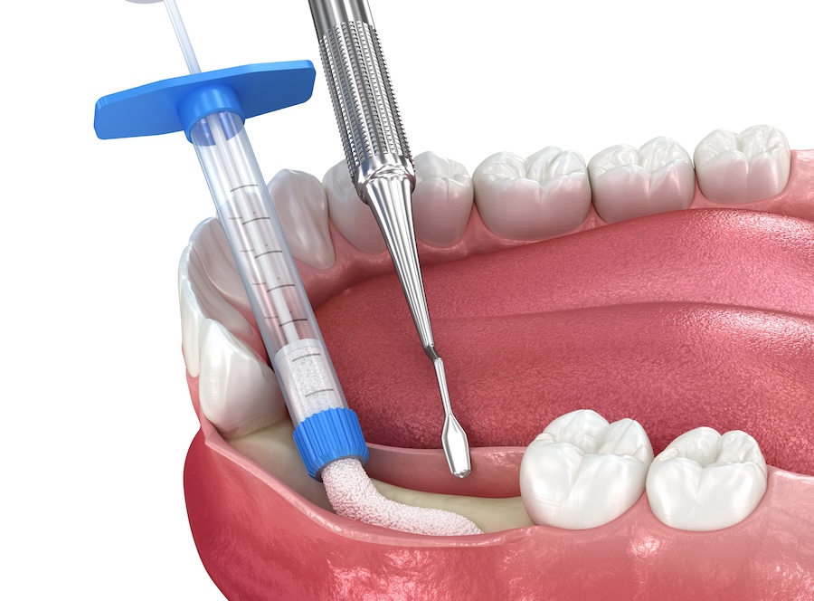 bone grafting to restore bone level before dental implant