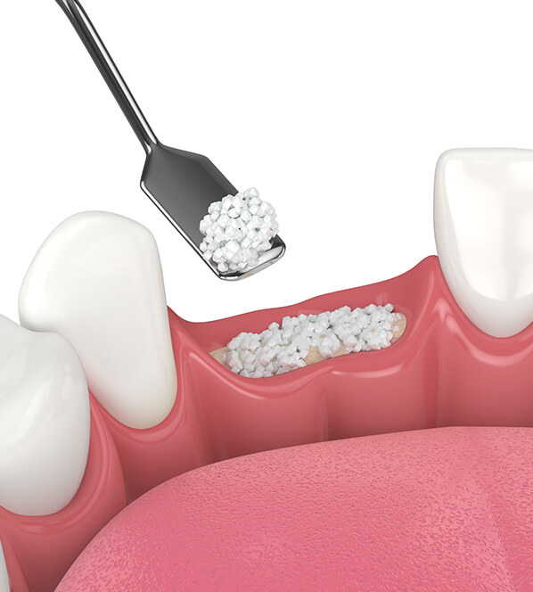 digital rendering of a bone graft