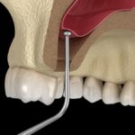sinus lift and bone grafting for dental implants