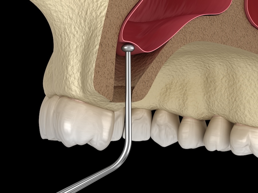 sinus lift and bone grafting for dental implants