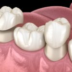 dental crown, dental bridge