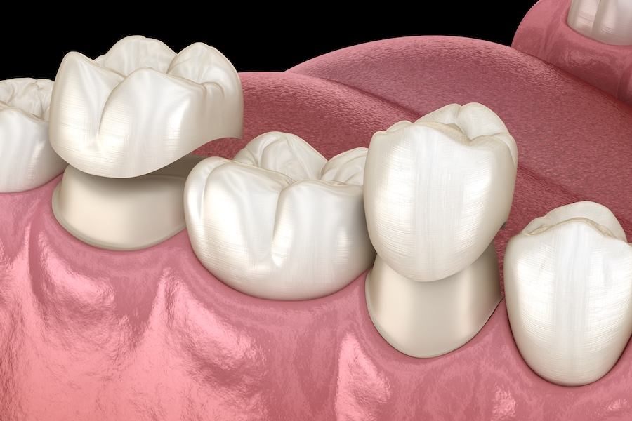 dental crown, dental bridge
